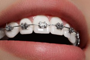 Achieve Optimal Oral Hygiene Through Adult Braces